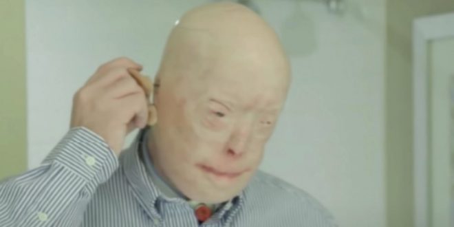 Patrick Hardison received a new face after third-degree burns, this is him today